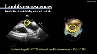 〖Echocardiography〗 Lambls excrescences amp fibroelastoma in TEE 🫀 [upl. by Menides798]