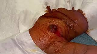 removal of granuloma from a hand [upl. by Kurt]