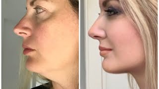 Before and after facelift and neck lift [upl. by Inahpets]