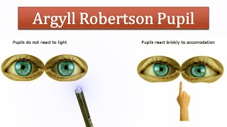 Argyll Robertson Pupil [upl. by Idnyc883]