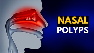 NASAL POLYPS Causes SIgns and Symptoms Diagnosis and Treatment [upl. by Emyaj]