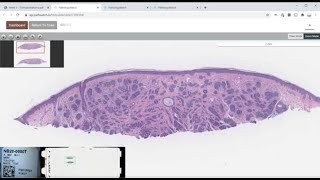 Trichoepithelioma [upl. by Ahsaekal117]