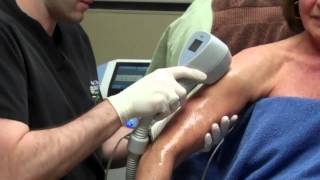 Exilis for Skin Tightening on a Womans Arms with Dr Seiler [upl. by Cramer]