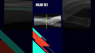 Distal radius fracture radiographic evaluation Volar tilt angle [upl. by Akinohs]