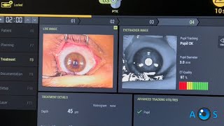 Contoura PRK amp Corneal Crosslinking for Treatment of Keratoconus  Irregular Astigmatism [upl. by Atterahs]