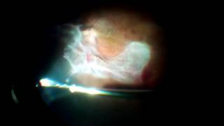 Diabetic tractional retinal detachment with dense subretinal fluid [upl. by Anner]