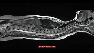 Ressonância magnética da coluna cervical dorsal e lombar [upl. by Nnyleve966]