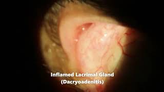 Dacryoadenitis Swollen Lacrimal Gland Coming Out of Eye [upl. by Garrett]