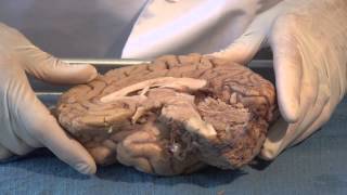 The Ventricles Neuroanatomy Video Lab  Brain Dissections [upl. by Ahsinom]