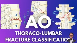 AO Classification Thoracolumbar Fractures [upl. by Zachariah486]