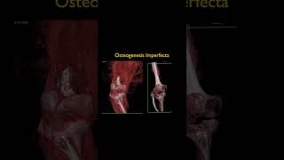 Osteogenesis Imperfecta [upl. by Anilocin280]