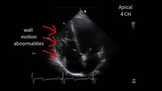 A special cardiomyopathy [upl. by Himelman]