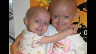 PRF  Progeria clinical drug trial [upl. by Animahs]