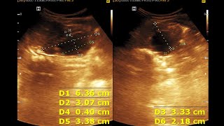 Hydro nephrosis Infant Kidney  Dilated Renal Pelvis [upl. by Acenahs]