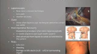 What is a Cholecystectomy [upl. by Ettedanreb692]