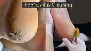 Callus Removal From Feet 👣 Foot Callus Removal Satisfying [upl. by Arolf156]