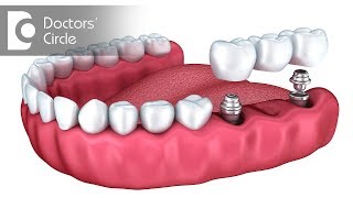 Can one replace multiple teeth using Dental Implants  Dr Mohammed Fayaz Pasha [upl. by Quin850]