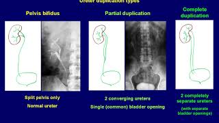 Intravenous Urography basics [upl. by Labotsirhc]