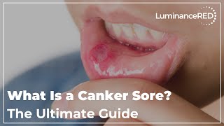 What Is a Canker Sore The Ultimate Guide [upl. by Georgine886]