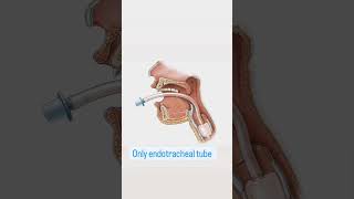 Laryngoscope insert endotracheal tube [upl. by Morlee998]