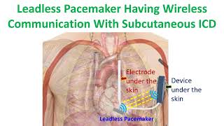 Leadless pacemaker having wireless communication with subcutaneous ICD [upl. by Nair13]