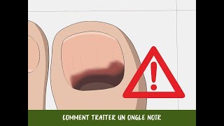 Comment traiter un ongle noir [upl. by Ayamahs]