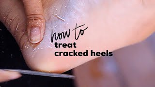 DIY PEDICURE FOR CRACKED HEELS  How to Treat Cracked Heels At Home [upl. by Ailaroc]