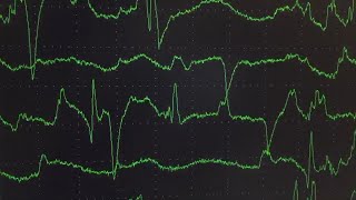 Electromyography EMG Findings in Progressive Encephalomyelitis With Rigidity and Myoclonus PERM [upl. by Paul159]