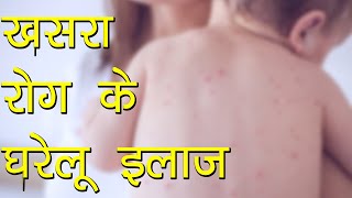 खसरा रोग के घरेलू इलाज  Khasra ka Desi ilaz  Treatment of Measles  Ayurvedic Samadhan [upl. by Hogle]