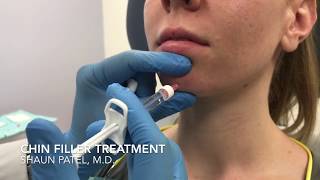 Chin augmentation with filler Restylane Lyft by Dr Shaun Patel [upl. by Moser]