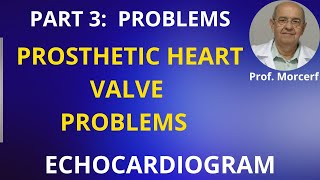 Problems With Prosthetic Valves Part 3 [upl. by Annas]