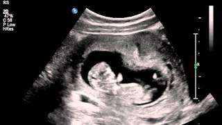 Jumping womb dancer baby ultrasound scan [upl. by Eloisa128]