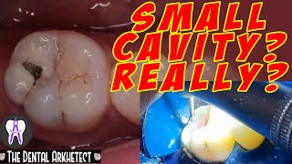 Molar Tooth Caries Removal and Restoration Pasta sa Bagang42 [upl. by Rise717]