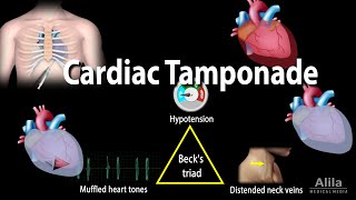 Cardiac Tamponade Pathophysiology Etiology Symptoms Diagnosis and Management Animation [upl. by Epolenep718]