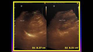 Ultrasound cases 453 of 2000  Complex right ovarian mass [upl. by Monique]