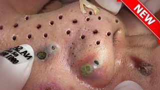 Top 5 Videos to Remove Monster Blackheads In The Ear [upl. by Ragen]