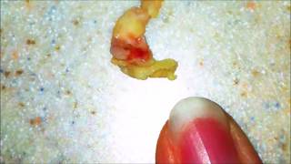 Worlds Largest Tonsil Stones  Cured [upl. by Eilraep]