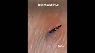 Ingrown Hari Removal  Blackheads Removal  Whiteheads Removal Clip 10 [upl. by Ymia416]