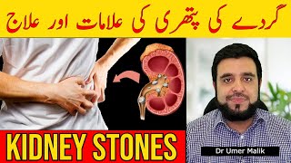 Gurde Mein Pathri Ki Alamat Gurday Ka Dard Gurde me Stone Kidney Stones Ka Ilaj Pathri Ka Ilaaj [upl. by Neelrac]