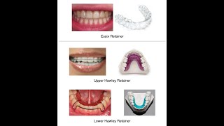 All about RETAINERS [upl. by Eelac]