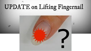 Tea Tree Oils Healing Powers On My LIFTED Fingernail  ONYCHOLYSIS  Does it Work  Watch Update [upl. by Olim]