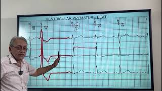 VENTRICULAR ECTOPICS  VENTRICULAR PREMATURE BEATS HOW TO DIAGNOSE ON ECG [upl. by Tench116]