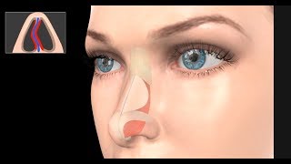 Deviated Septum Surgery Septoplasty [upl. by Kacey713]