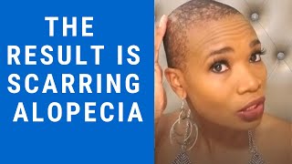 Alopecia diagnosis  emotional journey  will my hair grow back [upl. by Einoj]