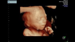 20 week ultrasound [upl. by Caras]