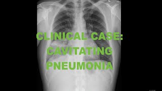 Clinical Case  Cavitating pneumonia  Chest Xray and CT Scan  Radiology tutorial [upl. by Lanevuj70]