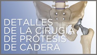 Detalles de la cirugía de prótesis de cadera Dr Ángel Villamor [upl. by Iadahs]