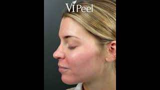 VI Peel Process  What To Expect When Youre Peeling [upl. by Nnaer]