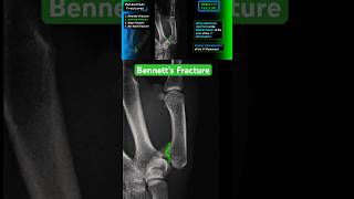 Thumb Fracture  Bennett’s fracture shorts radiology xray trauma [upl. by Alinna]