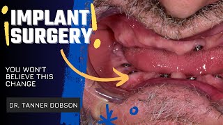 51 Full Mouth Dental Implant Reconstruction Surgery Live All on 6 Part 1 [upl. by Pride]